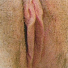 Aldara - kondylomer - etter behandling
