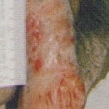 Aldara - kondylomer - under behandling