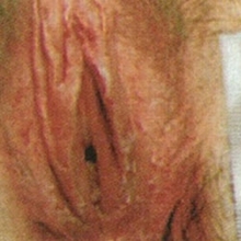 Aldara - kondylomer - under behandling