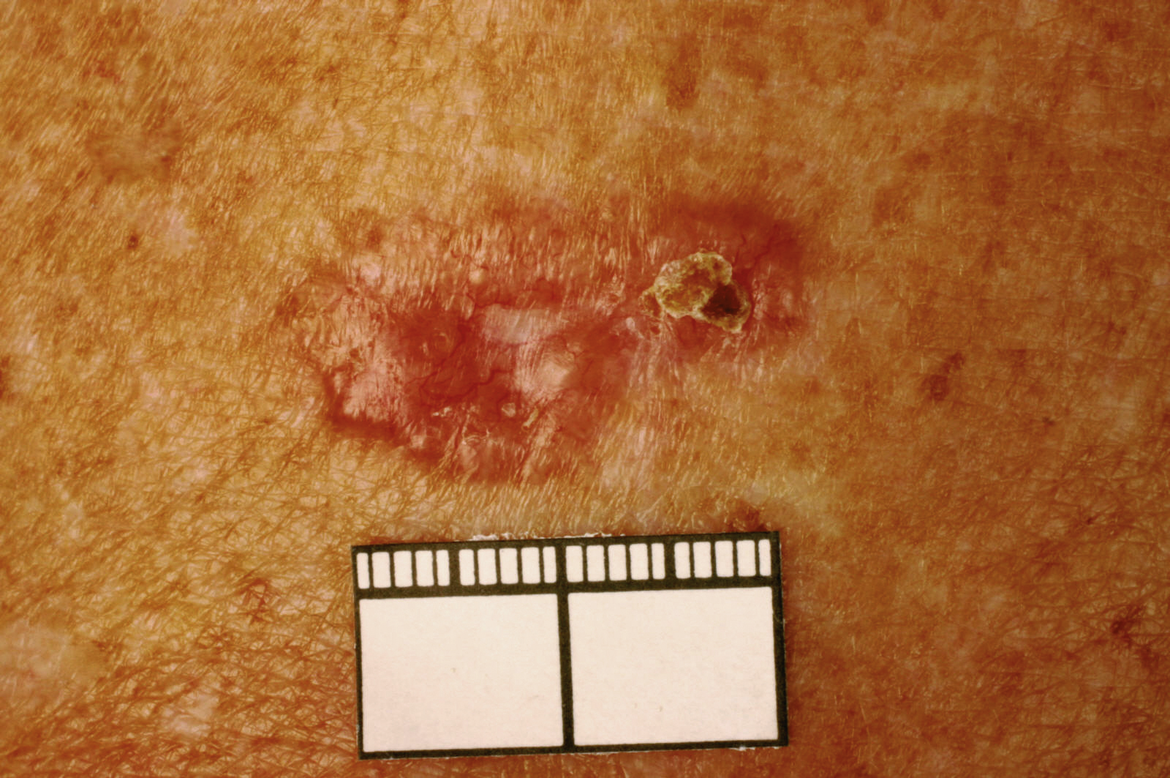 2. Basalcellscancer