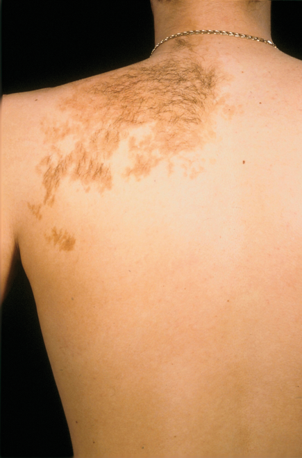 Beckers nevus 1 Beckers nevus 1
