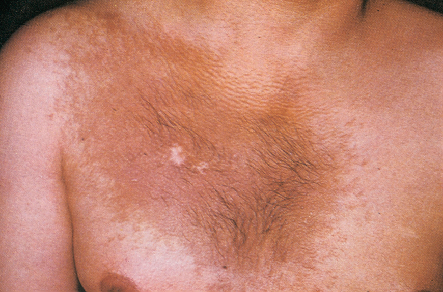 Beckers nevus 2 Beckers nevus 2