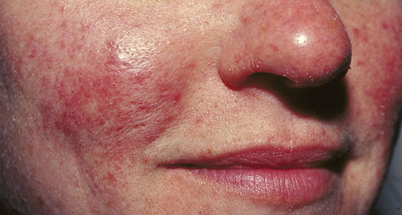Rosacea