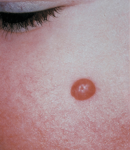 Spitz nevus